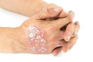 Псориаз: от чего появляется, симптомы и лечение